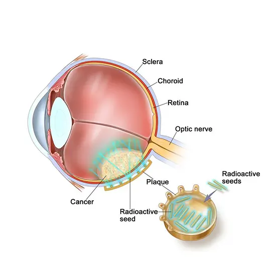 Uveal Melanoma : A Closer Look At This Uncommon Eye Cancer